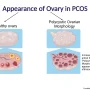 PCOS Berganti Nama Menjadi PMOS: Apa yang Berubah?