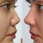 Rina Nose Alami Post-Op Blues Setelah Operasi Hidung, Kaget dan Cemas!