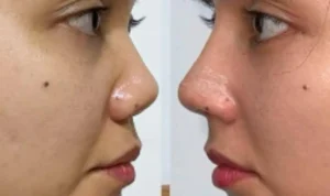 Rina Nose Alami Post-Op Blues Setelah Operasi Hidung, Kaget dan Cemas!