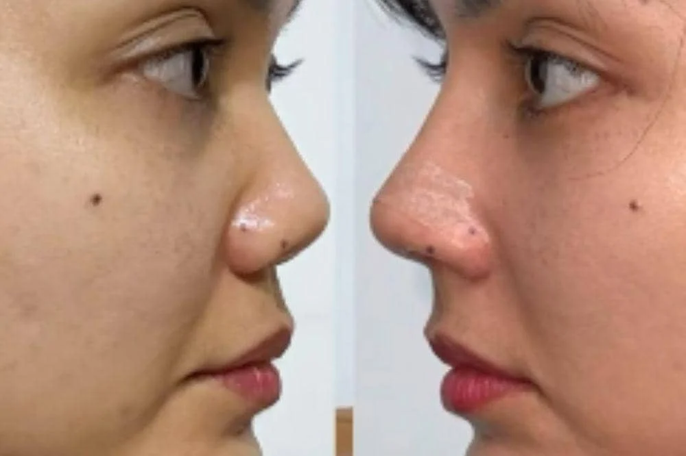 Rina Nose Alami Post-Op Blues Setelah Operasi Hidung, Kaget dan Cemas!