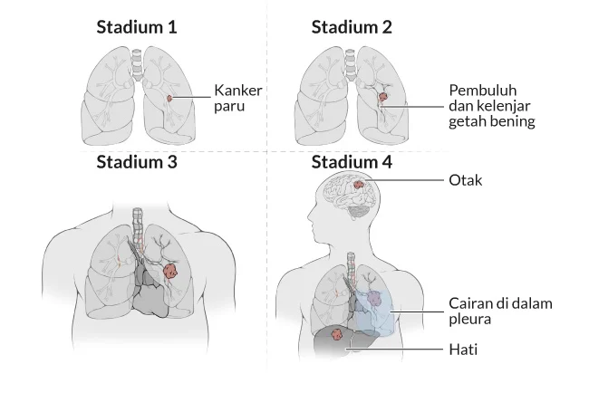 Suku Bunga dan Kanker Paru-Paru: Dua Berita yang Menghebohkan