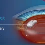 SpyGlass Pharma Meluncurkan Terobosan Baru dalam Pengobatan Glaukoma dengan BIM-IOL System